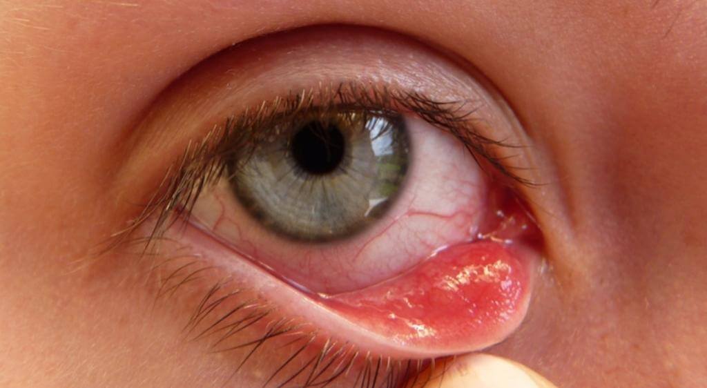 Viêm kết mạc do virus là nguyên nhân phổ biến khiến mắt đổ ghèn và đỏ