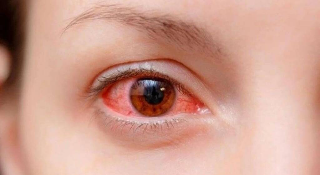 Viêm kết mạc là một trong các nguyên nhân khiến mắt bị đổ ghèn