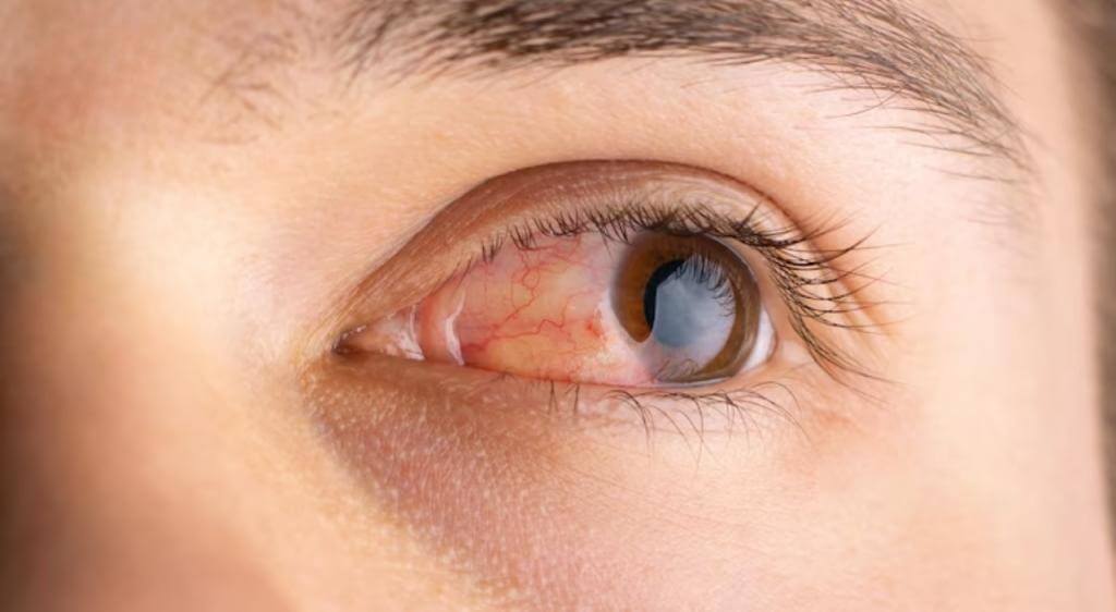 Viêm nhiễm kích thích mắt tiết nhiều nước mắt để tự bảo vệ và làm sạch