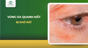vùng da quanh mắt bị khô rát