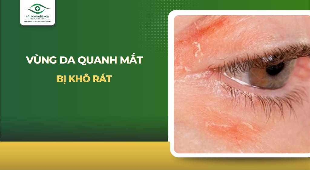 vùng da quanh mắt bị khô rát
