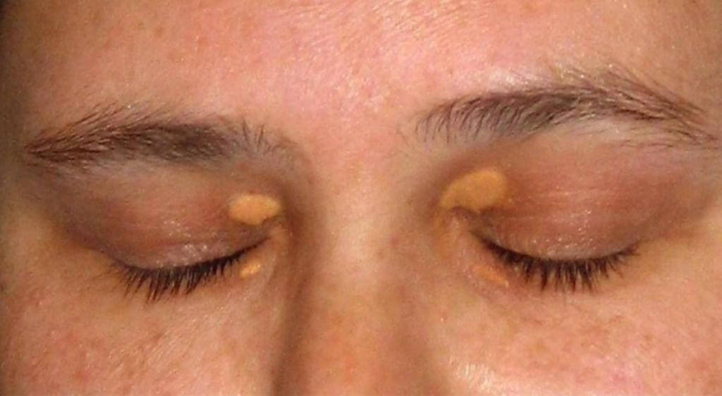 Vùng da quanh mắt bị vàng là dấu hiệu của bệnh xanthelasma (ban vàng mí mắt)