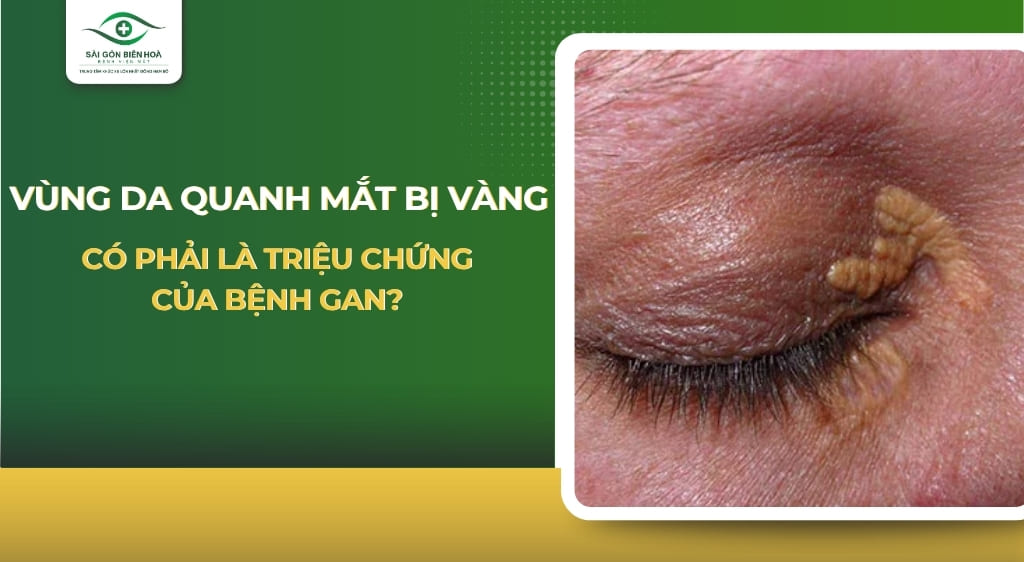 Vùng da quanh mắt bị vàng