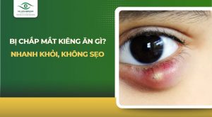 Bị chắp mắt kiêng ăn gì