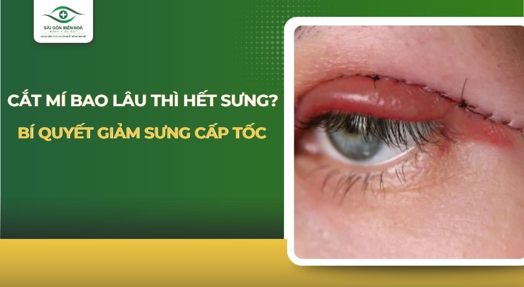 Cắt mí bao lâu thì hết sưng