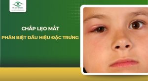chắp lẹo mắt