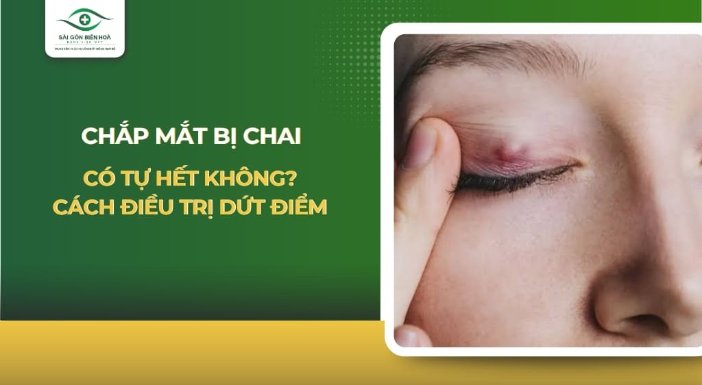 Chắp mắt bị chai