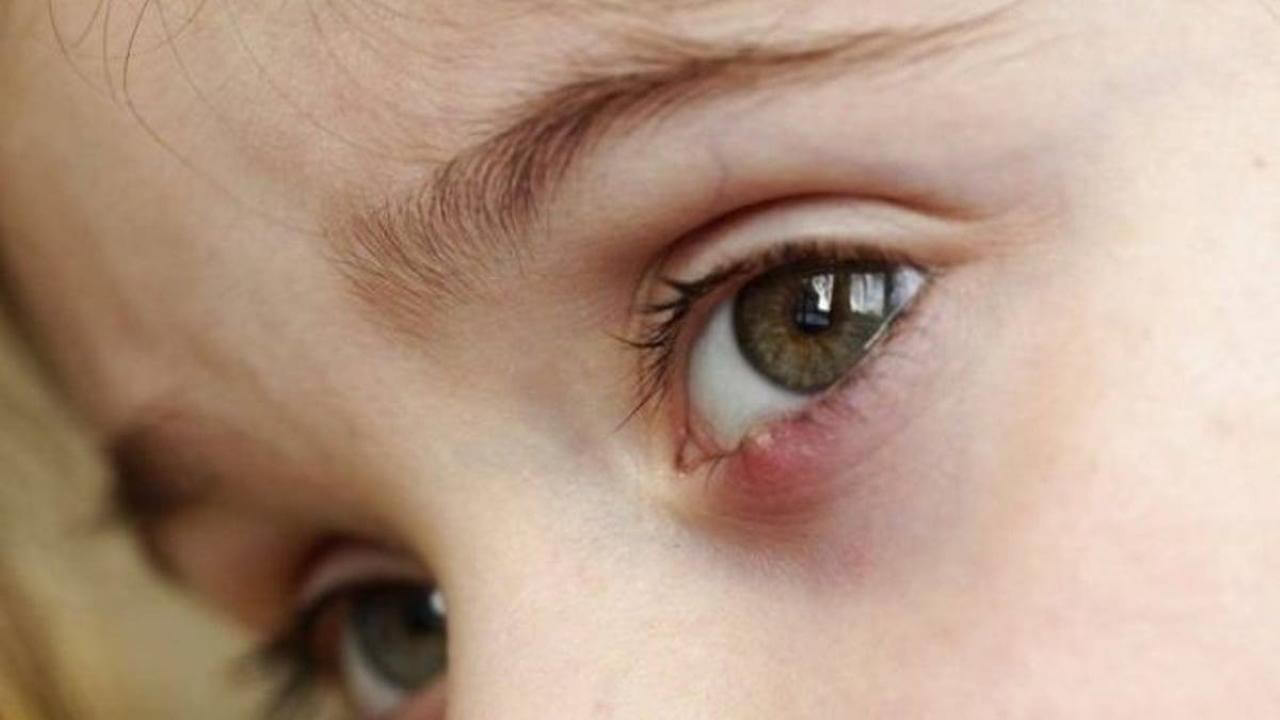 Chắp mắt bị vỡ mủ thường không quá nguy hiểm