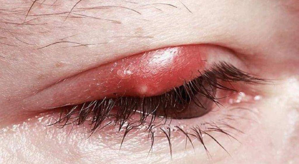 Chắp mắt bội nhiễm gây sưng đỏ, mưng mủ, biến chứng khi chăm sóc không đúng cách