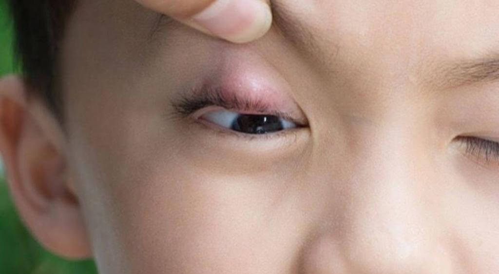 Chắp mắt ở trẻ lớn thường biểu hiện bằng khối sưng hoặc cục chắc dưới mi mắt