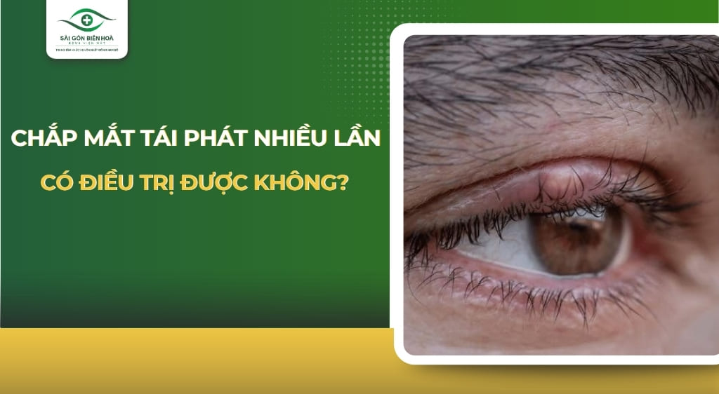 Chắp mắt tái phát nhiều lần