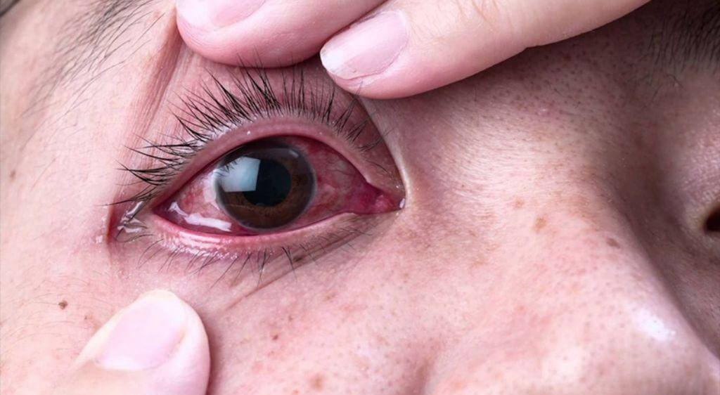Đau mắt hàn gây cộm xốn, đỏ rát và đau nhức dữ dội