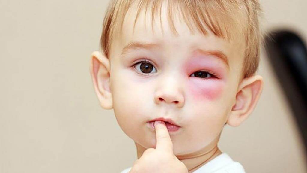 Đỏ, sưng, ngứa mắt sau khi nhỏ kháng sinh là biểu hiện trẻ có thể gặp
