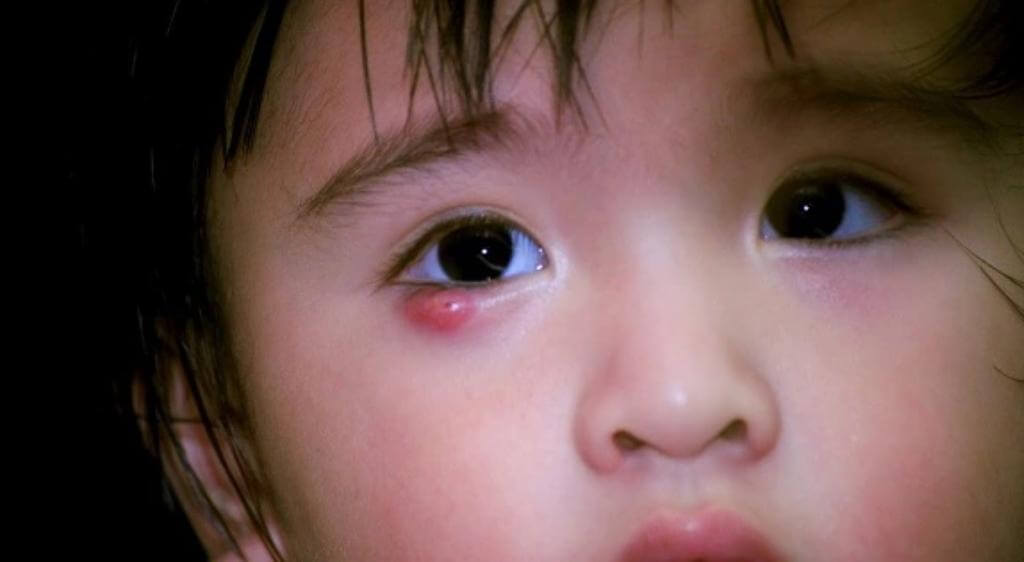 Đưa trẻ đi khám nếu chắp kéo dài hoặc xuất hiện dấu hiệu bất thường