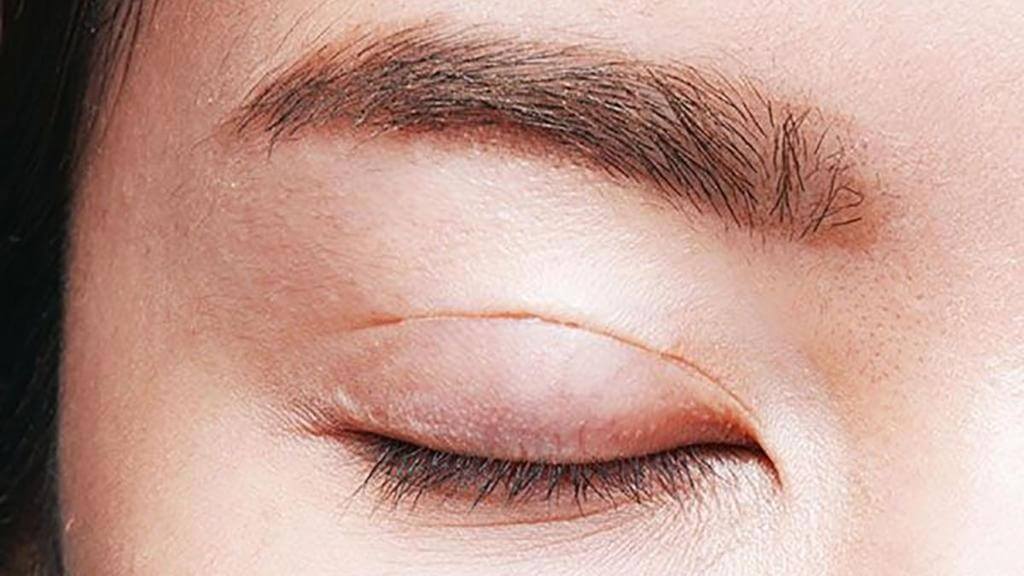 Hầu hết các trường hợp chích chắp mắt sẽ không để lại sẹo