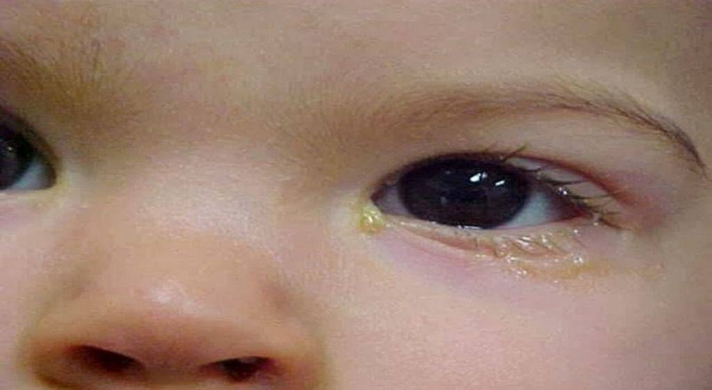 Mắt trẻ sơ sinh bị đổ ghèn thường bắt nguồn từ nhiều nguyên nhân nhân khác nhau