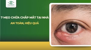 mẹo chữa chắp mắt