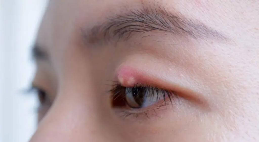 Mổ chắp mắt bao nhiêu tiền thường phụ thuộc vào nhiều yếu tố khác nhau
