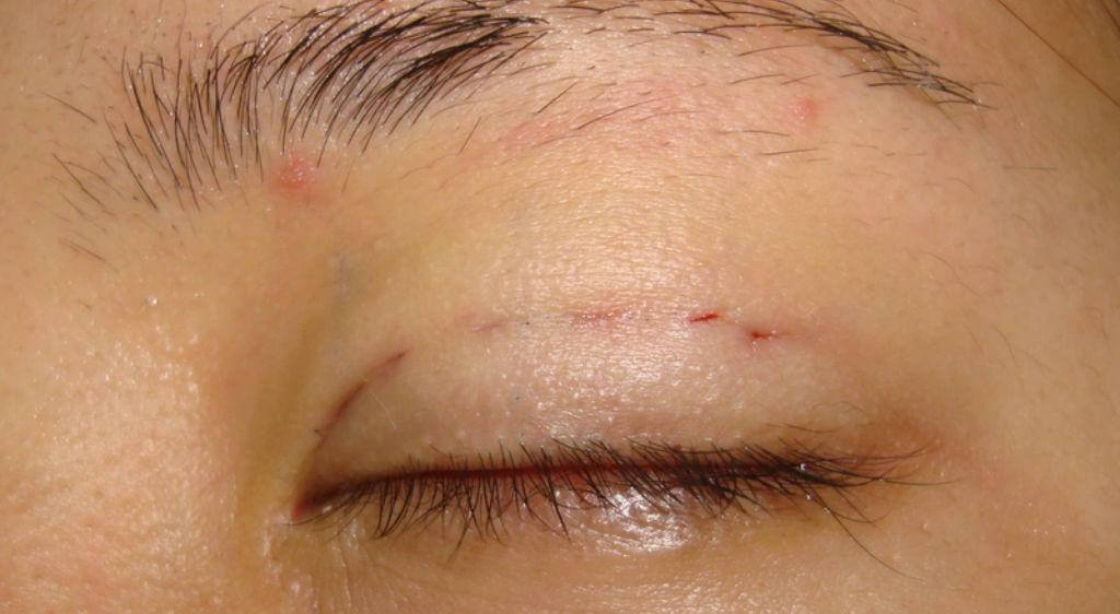 Nhấn mí vẫn gây sưng nhẹ trong vài ngày đầu sau khi thực hiện