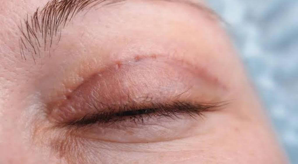 Ở ngày thứ 2 và 3, phản ứng viêm đạt đỉnh điểm, vùng mí mắt tích tụ tối đa huyết tương dẫn đến sưng to