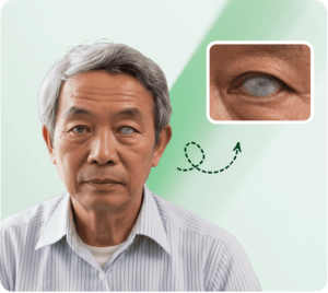 Phẫu thuật đục thủy tinh thể