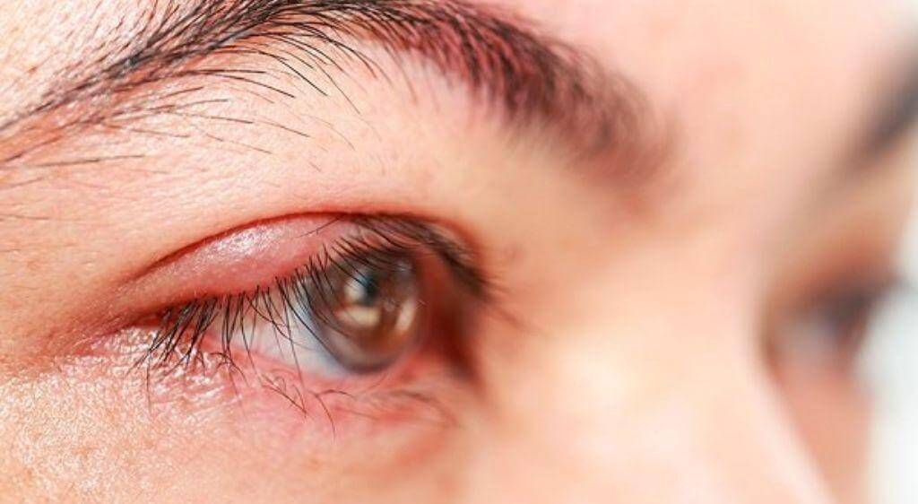 Tự ý dùng thuốc bừa bãi có thể gây viêm, sưng nặng hơn