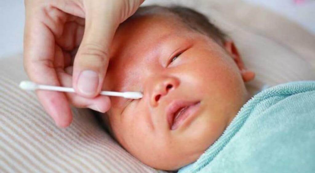 Vệ sinh mí mắt hằng ngày giúp giảm bã nhờn, loại bỏ vi khuẩn và hạn chế bội nhiễm