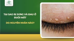 Bị đau và sưng ở đuôi mắt