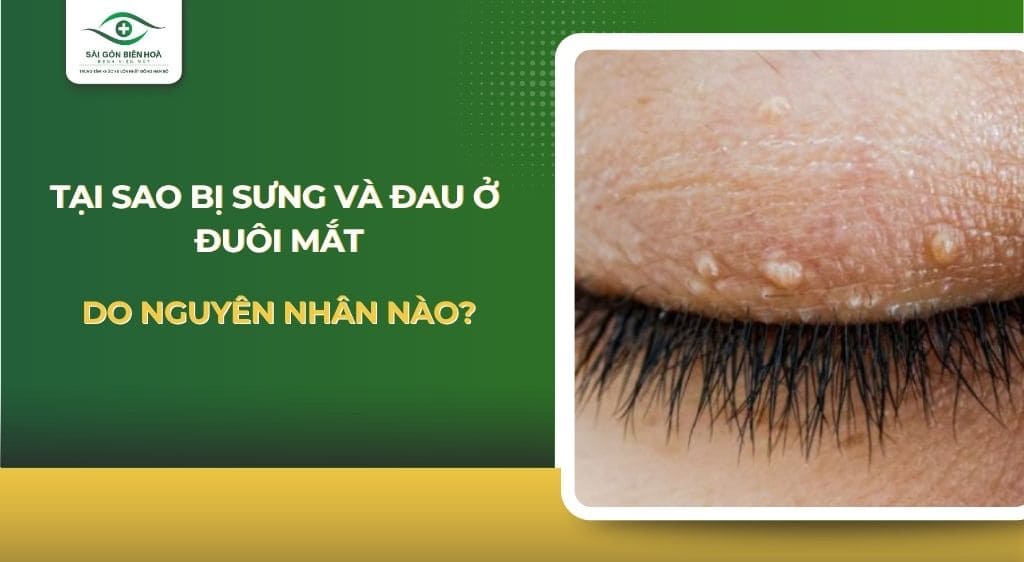 Bị đau và sưng ở đuôi mắt