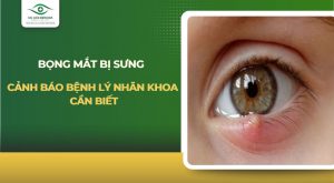 Bọng mắt bị sưng