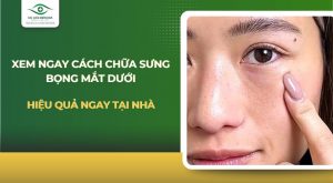 cách chữa sưng bọng mắt dưới