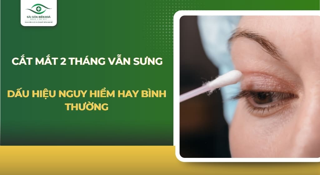 cắt mí 2 tháng vẫn sưng