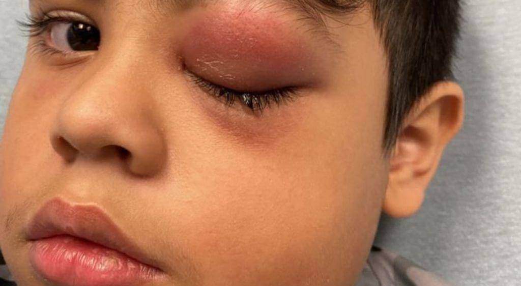 Cấu trúc da quanh mắt của trẻ rất mỏng và lỏng lẻo nên dễ bị sưng nề sau va đập.