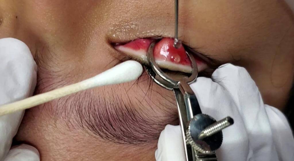 Chích rạch chắplẹo giúp dẫn lưu mủ, giảm sưng đau nhanh chóng