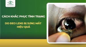 Đeo lens bị sưng mắt