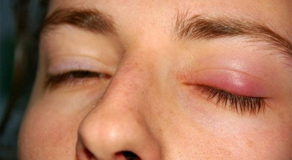Dị ứng thường gây sưng cả hai mí mắt kèm ngứa, đỏ nhẹ và chảy nước mắt