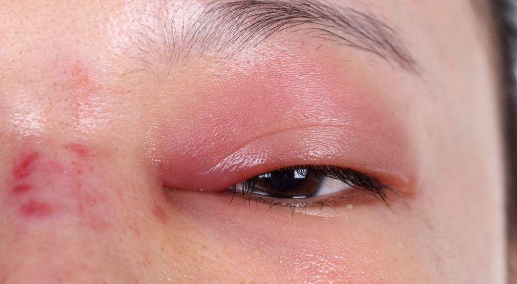 Hiện tượng sưng mắt là một triệu chứng lâm sàng phản ánh sự tích tụ dịch lỏng hoặc phản ứng viêm nhiễm của mắt