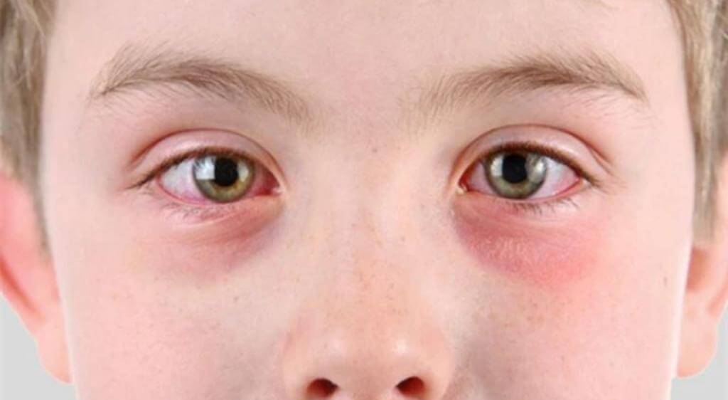 Histamine là nguyên nhân chính gây sưng mắt khi dị ứng hải sản