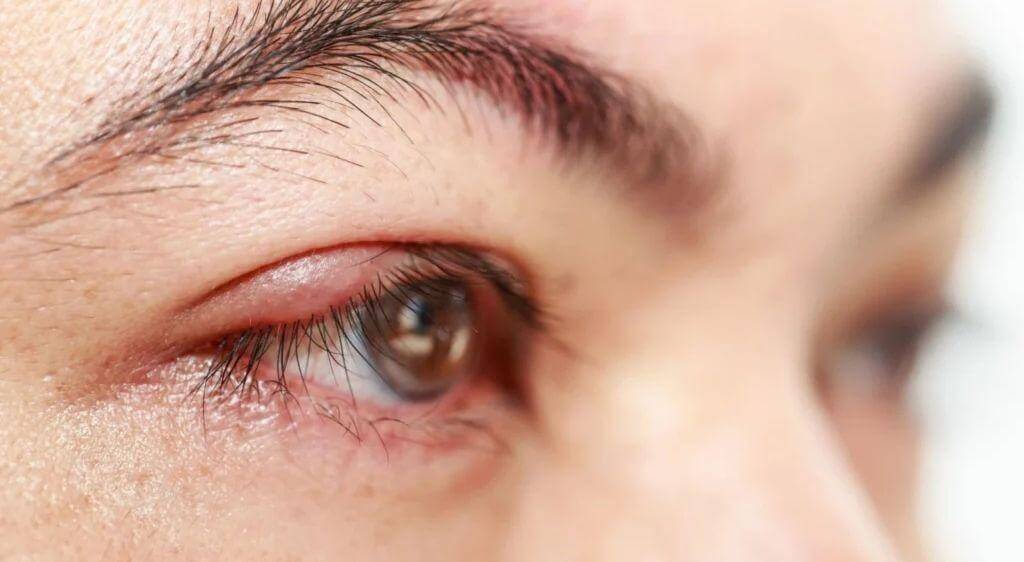 Lẹo mắt chính là một trong những nguyên nhân hàng đầu khiến mắt bị sưng đau dữ dội