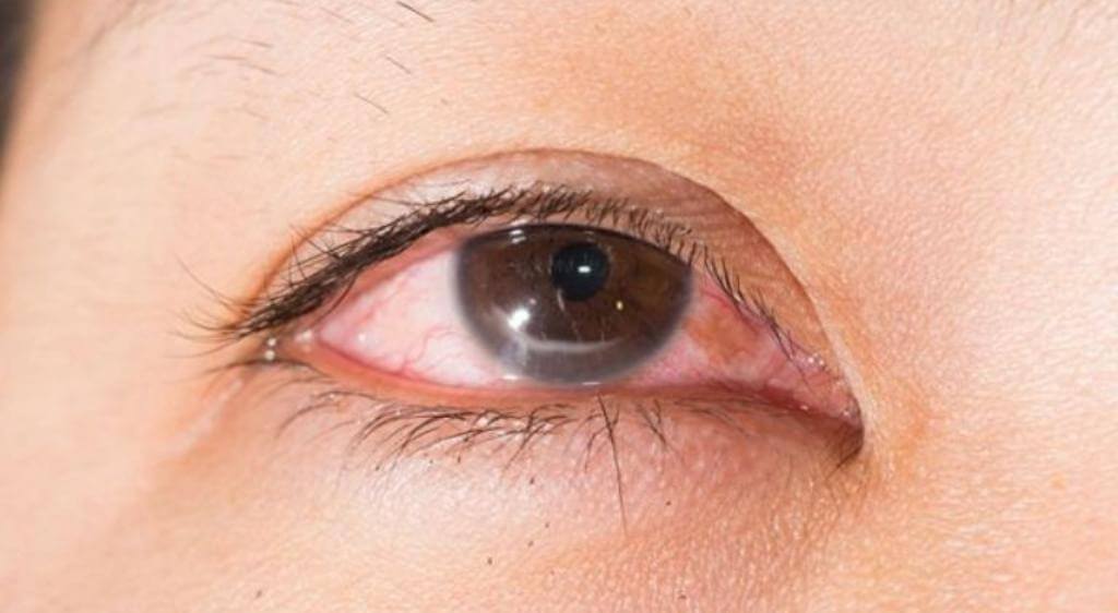 Mắt bị đau nhức, kèm nổi đỏ có thể là dấu hiệu nhiễm khuẩn vùng mí mắt