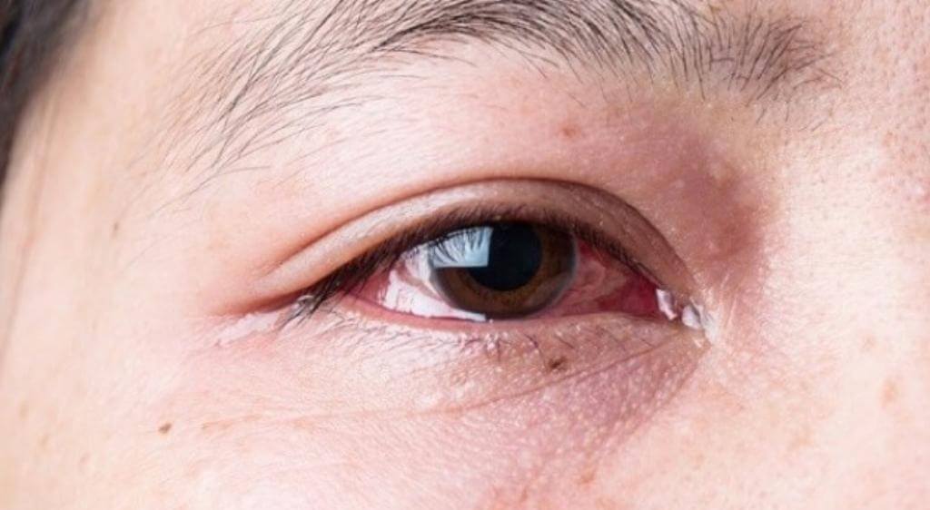 Mắt sưng kéo dài kèm dấu hiệu bất thường cần được thăm khám sớm