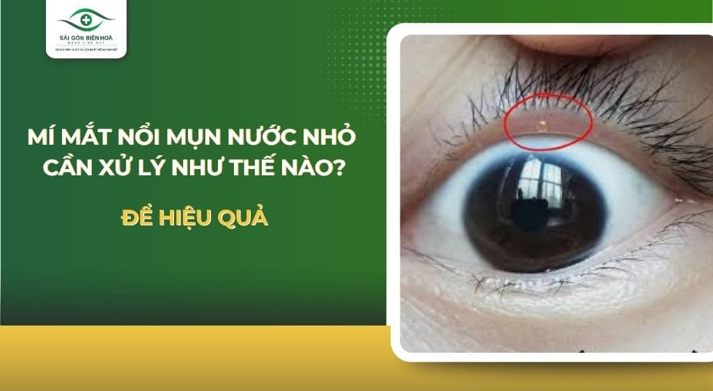 mí mắt nổi mụn nước nhỏ