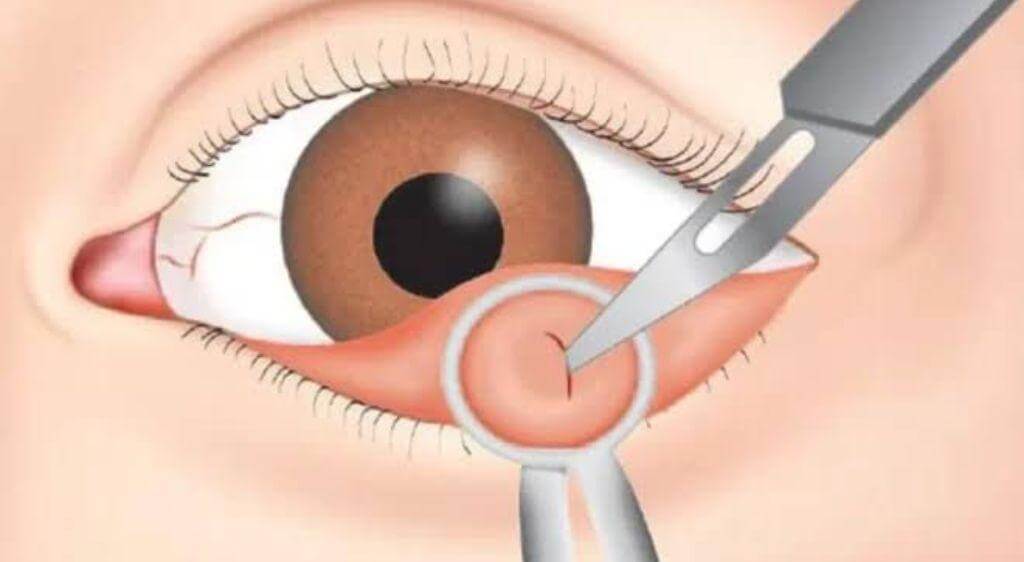 Mổ chắp mắt không gây đau và không để lại sẹo sau phẫu thuật