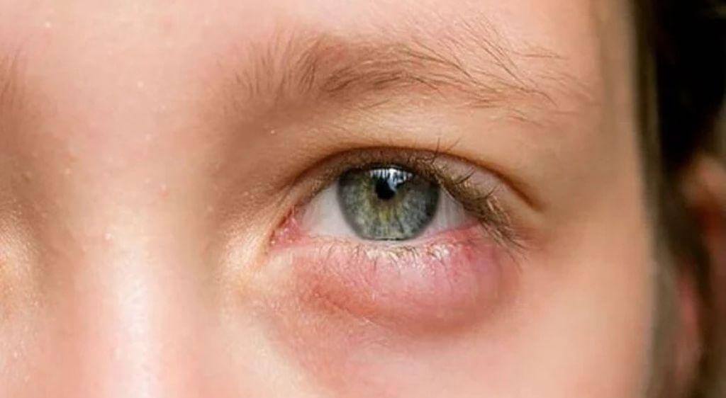 Nếu đeo lens bị sưng mắt dẫn đến mắt sưng húp, phù nề thì bạn cần đi khám ngay lập tức để bảo vệ thị lực