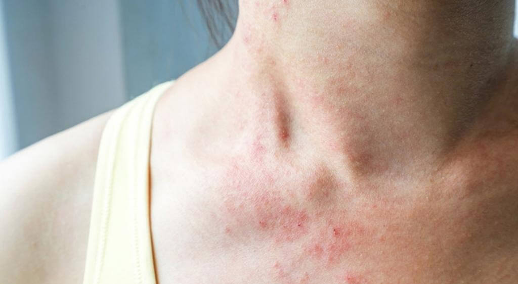 Người có tiền sử dị ứng hải sản là nhóm người yếu tố nguy cơ hàng đầu
