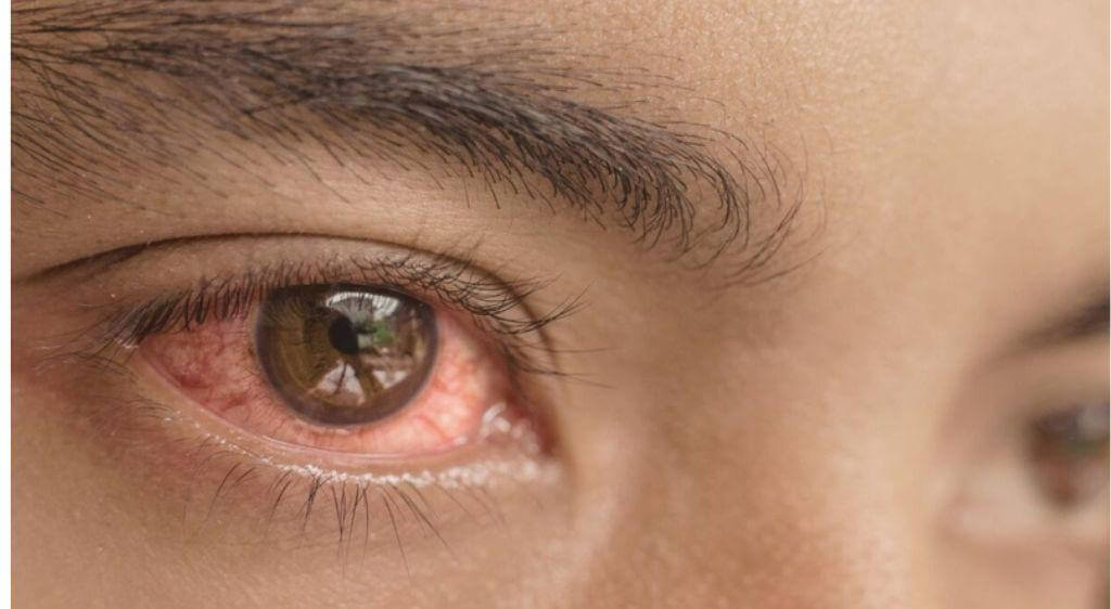 Nguyên nhân đau mắt đỏ sưng húp do virus, vi khuẩn hoặc dị ứng