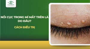 Nổi cục trong mí mắt trên