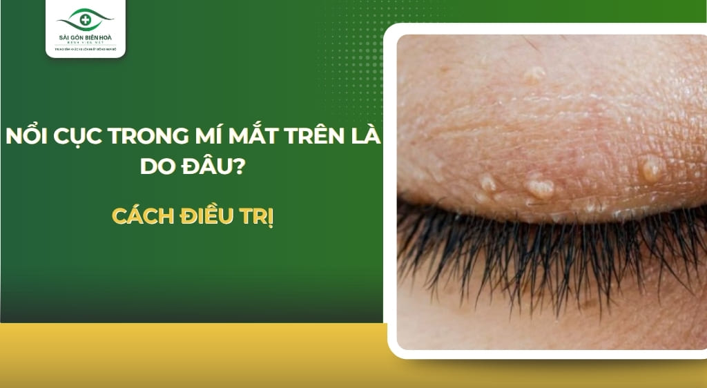 Nổi cục trong mí mắt trên