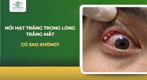 Nổi hạt trắng trong lòng trắng mắt