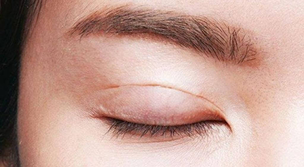 Sưng kéo dài sau 2 tháng có thể liên quan đến biến chứng hậu phẫu thuật